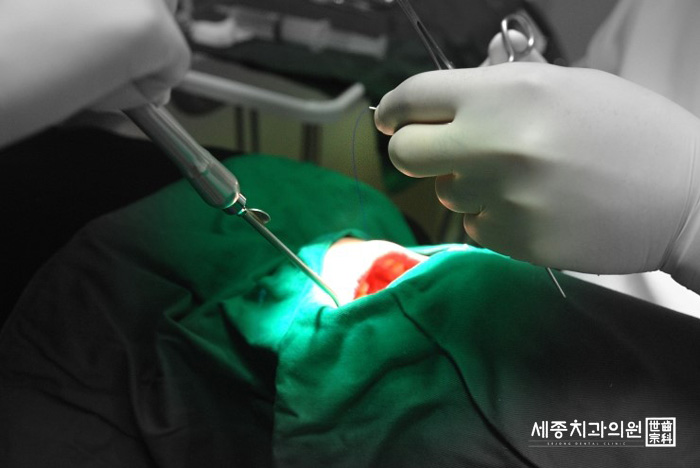 사랑니발치 리얼스토리10.jpg