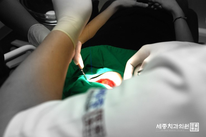 사랑니발치 리얼스토리11.jpg