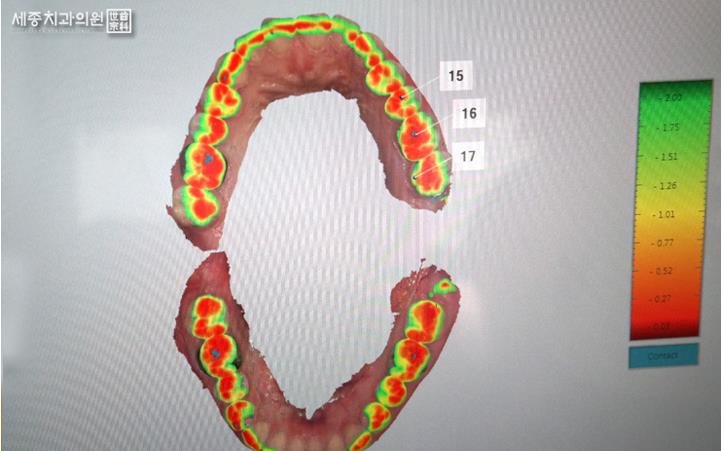 구강스캐너 (10).jpg
