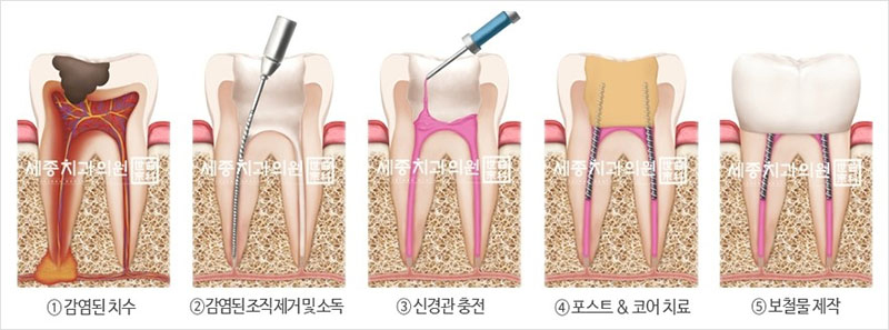 신경치료과정.jpg