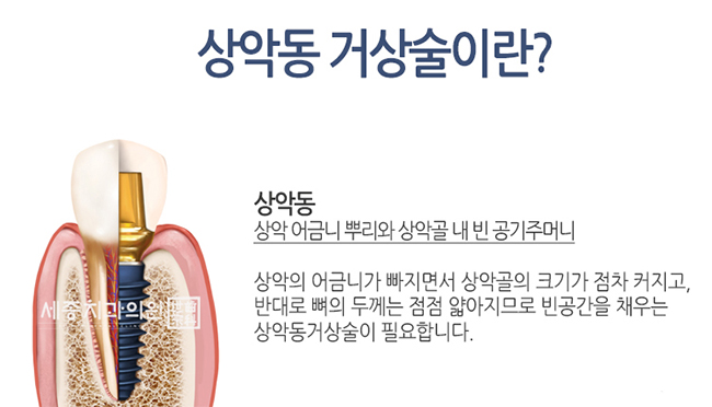 상악동거상술1.jpg